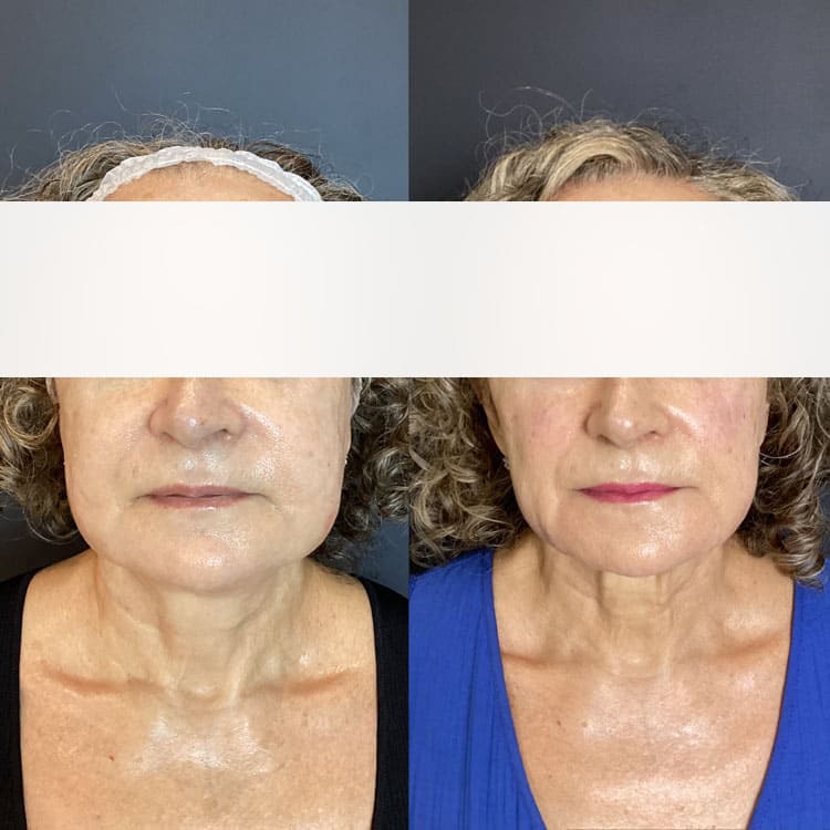 Después del tratamiento - Cliente 2