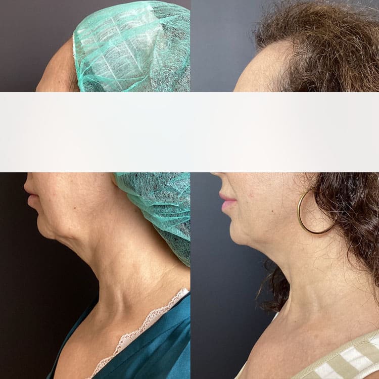 Después del tratamiento - Cliente 3